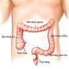Chìa khoá giúp giảm tỷ lệ tử vong do ung thư đại trực tràng